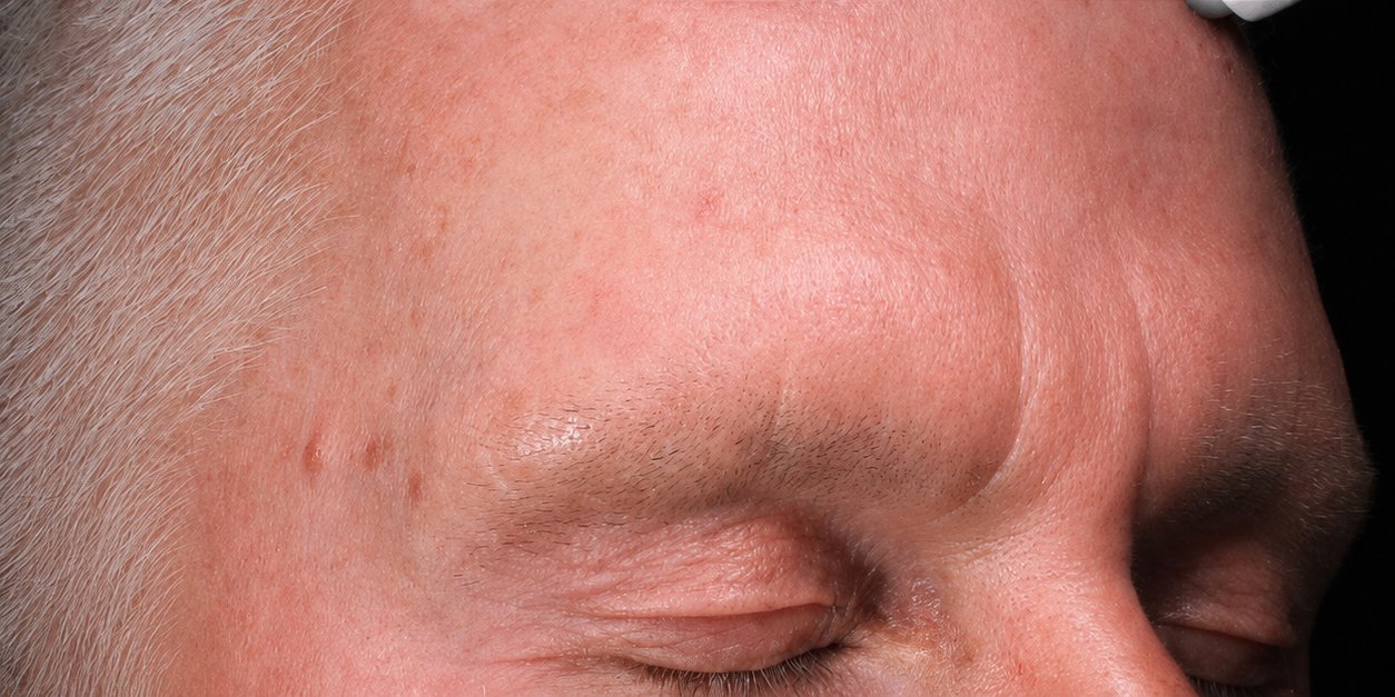 Efter - Botox mellem brynene