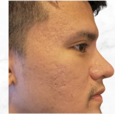 Efter - Microneedling - aknear