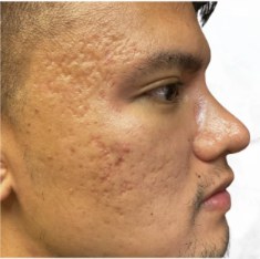 Før - Microneedling - aknear
