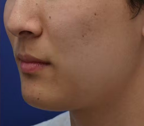 Efter - Microneedling - porer og ar