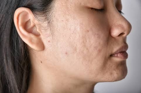 Før - Microneedling - hudstruktur