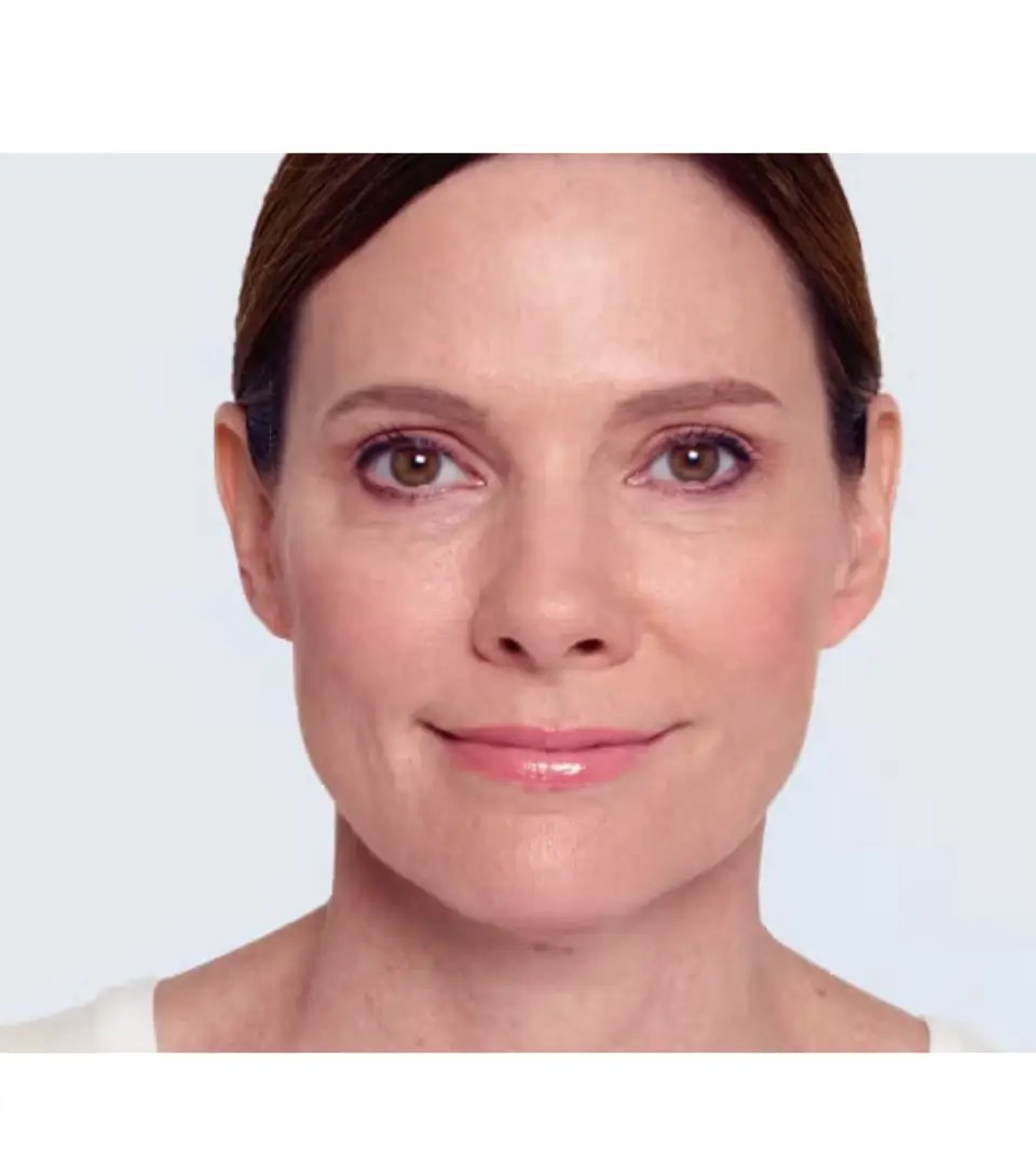 Efter - Skinbooster i ansigt