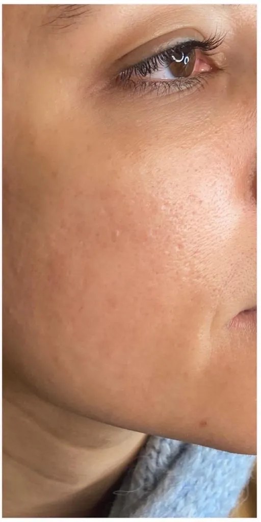Efter - Skinbooster - hudkvalitet
