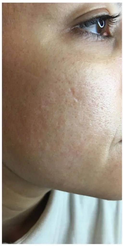 Før - Skinbooster - hudkvalitet