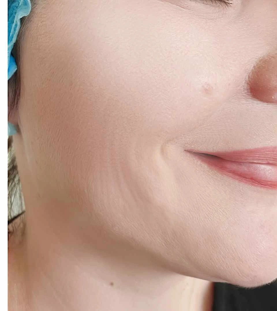 Efter - Skinbooster - kind & linjer