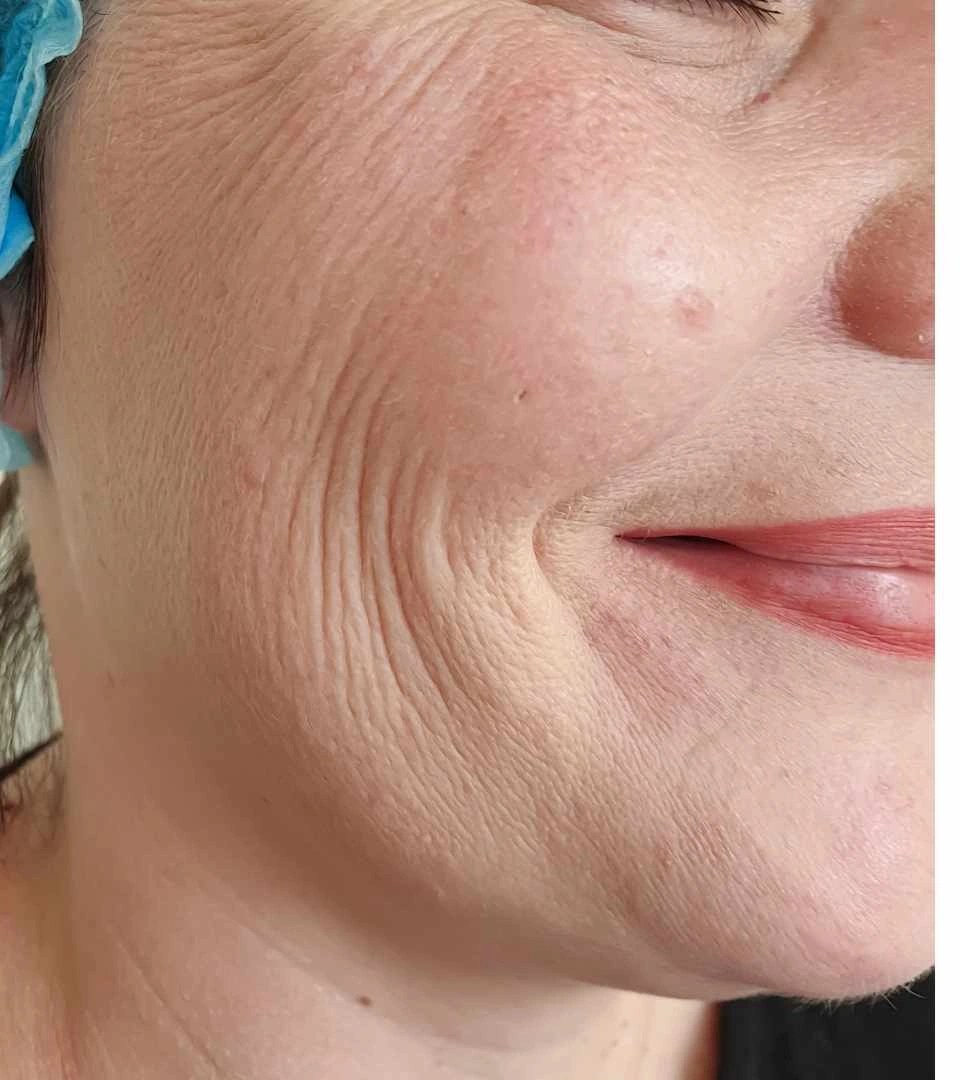 Før - Skinbooster - kind & linjer